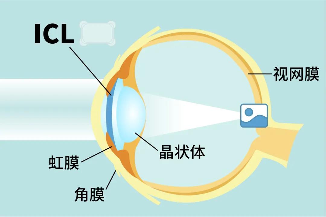 为什么越来越多人摘镜会选择ICL晶体植入术？